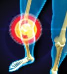  Methods to treating arthritic knees